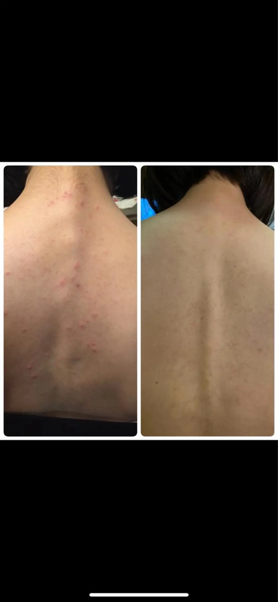 ニキビ特化美容鍼 ×ハーブピーリングのエステ・リラクイメージ