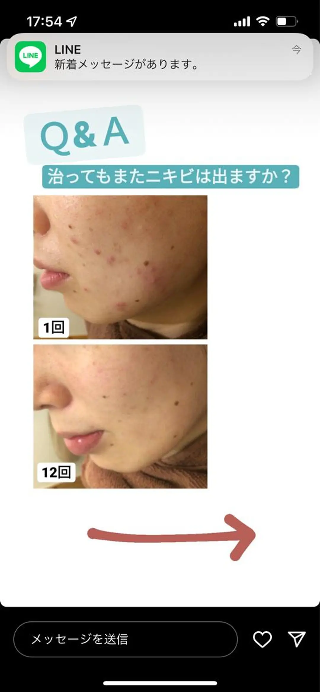 ニキビ跡改善専門🔥 医療にはできない改善のエステ・リラクイメージ