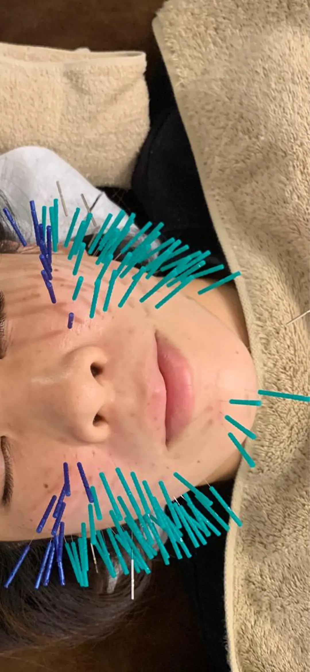 表参道鍼灸院K 美容鍼🔮ララピールのエステ・リラクイメージ