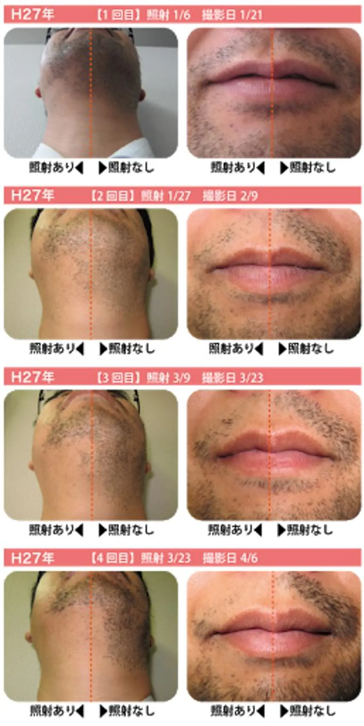 脱毛 高速脱毛エステ リアンのエステ・リラクイメージ