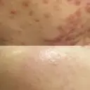 ニキビ跡改善専門🔥 医療にはできない改善のプロフィール画像