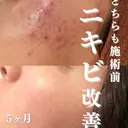 ニキビ跡改善専門🔥 医療にはできない改善のプロフィール画像