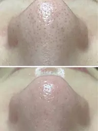 【新規限定✨毛穴の黒ずみ・角栓徹底ケア】tete式毛穴エクストラクション/フェイシャルマッサージ&選べるパック付💕