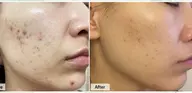 ハーブトリートメント🌿6回コース🌿モニター募集！限定3名のみ！【本気の肌改善】内容ご確認ください！
