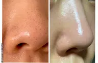 毛穴徹底洗浄