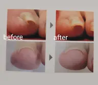 巻き爪ケア