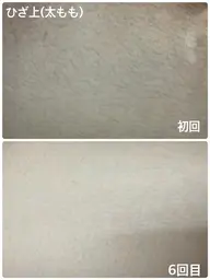 最新機械で痛みなしのVIO脱毛🎀安心安全シェービング付き✨