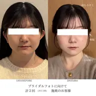 【ブライダルに向けた定着】miélu式小顔矯正　90min