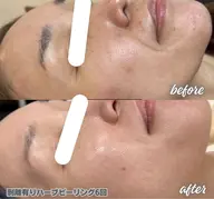 【初回鎮静ジェル付き!】肌質改善ハーブピーリング➕デコルテマッサージ🪸