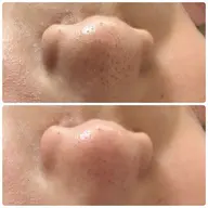【メンズフェイシャル🙎🏻♂️】毛穴・紫外線ケア💎お顔、首肩、ヘッドのマッサージ付き🌼毛穴汚れをスッキリ綺麗に✨