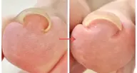 【巻き爪】親指1本🔴巻き爪、陥入爪❇️2回目も¥500💁‍♀️症例用モニター様募集