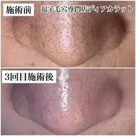 毛穴美コース お着替えなし70分 リピーター様割引あり