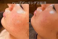 【剥離、ダウンタイムなし、肌質改善】ハーブピーリングMONNALI