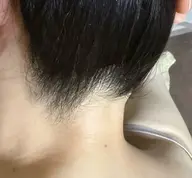部分脱毛　襟足