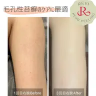 【ハーブピーリング】二の腕ケア★長年気になっていたぶつぶつもツルツルに♪