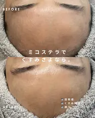 【お試し💉くすみしみ撃退】次世代肌育ジェットで即効美白