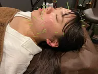 ⭐️平日(10​〜​16時)限定⭐️美容鍼(顔のみ)8800→5000