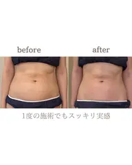 【1日1名まで】整体師が行うお腹やせ高周波トリートメント