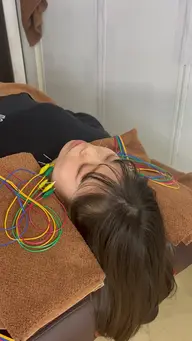 美容鍼