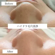 ハイドラ毛穴洗浄