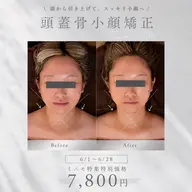 【6/1​〜​6/28⭐️ミニモ特集特別価格】頭蓋骨から整える小顔矯正💆‍♀️ 頭の重さ・顔の疲れ、スッキリ軽く✨