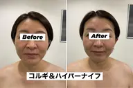 ハイパーナイフ＆コルギフェイシャル70分モニター