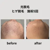 【光脱毛・ヒゲ脱毛】メンズ