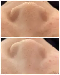 毛穴黒ずみ除去ツヤ肌フェイシャル🫧