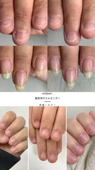 【重度深爪】自爪育成モニター