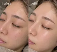 【HBL+フェイシャルWAX】セットクーポン