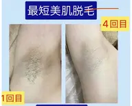 「9月限定★先着5名【全身＋顔＋VIO】ミニモ限定回数券★1回14000円​〜​」24回券は25回施術 → 1回13440円
