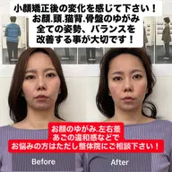 小顔矯正
