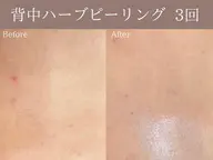 【背中ニキビ・ニキビ跡・ブライダル◎】背中ハーブピーリング