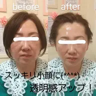 ❤今雑誌でも話題の最先端美容❤ヒト幹細胞培養液×美容鍼で小顔リフトアップ!肌質改善!