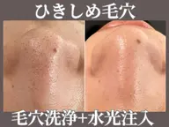 毛穴洗浄ハイドロフェイシャル(顔全体)+針なし水光