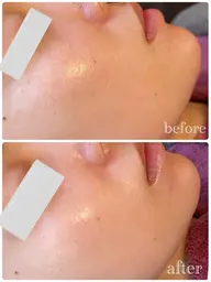 【ミニモSALE】💎剥離なし!ニキビ・毛穴改善◎肌再生ハーブピーリング60分