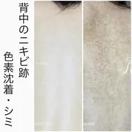 【背中ニキビ・毛孔性苔癬・シミ】背中ハーブピーリング