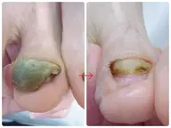 【分厚い爪、変形爪のケア】1本。症例用モニター様募集💁‍♀️皮膚から離れた箇所を丁寧に取り除きます✨