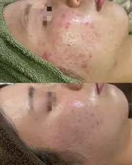【オーナー施術】本気の肌質改善|ニキビ・毛穴|剥離有りミネラルピーリング