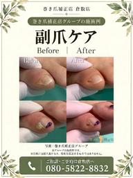 【副爪ケア】小指の爪横にある爪みたいなモノ💡キレイにします💁♀️