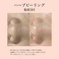 ミニモ限定価格【ニキビ/ザラつきにはこれ】ハーブピーリング、オイルデコルテ/肩/首マッサージ付き♪