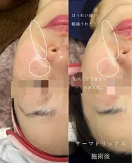 【お試しメニュー🌟】高周波サーマトリックス【2部位】