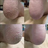 【カカト角質ケア】ガサガサ角質もツルスベに✨✨仕上がり大満足💁‍♀️◎