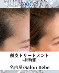 🇺🇸皮膚科医開発｜生え際や頭頂部の視線が気にならなくなる、毛量お悩みリセット育毛【プロセルセラピーズ】