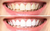 【セルフホワイトニング🦷】歯科医監修液剤と紫LED照射で1~3トーンUP✨