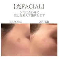 【本気の肌管理】光×RF×超音波×シミケア×氷結★シミ・たるみ・エイジングケア✨￥10,300