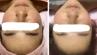 【モニター】フェイシャルWax60分
