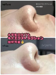 【ごっそり毛穴角栓】毛穴エクストラクション(鼻のみ)☆モニター様募集☆