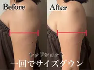 【レッドショット導入価格✨】韓国発🇰🇷最新美容脂肪撃退💉🩸二の腕またはお腹3cc導入❤️🔥EMSラジオ波付き