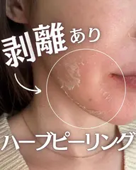 【剥離ありハーブピーリング】💎古い角質をケアして透明感UP🫧